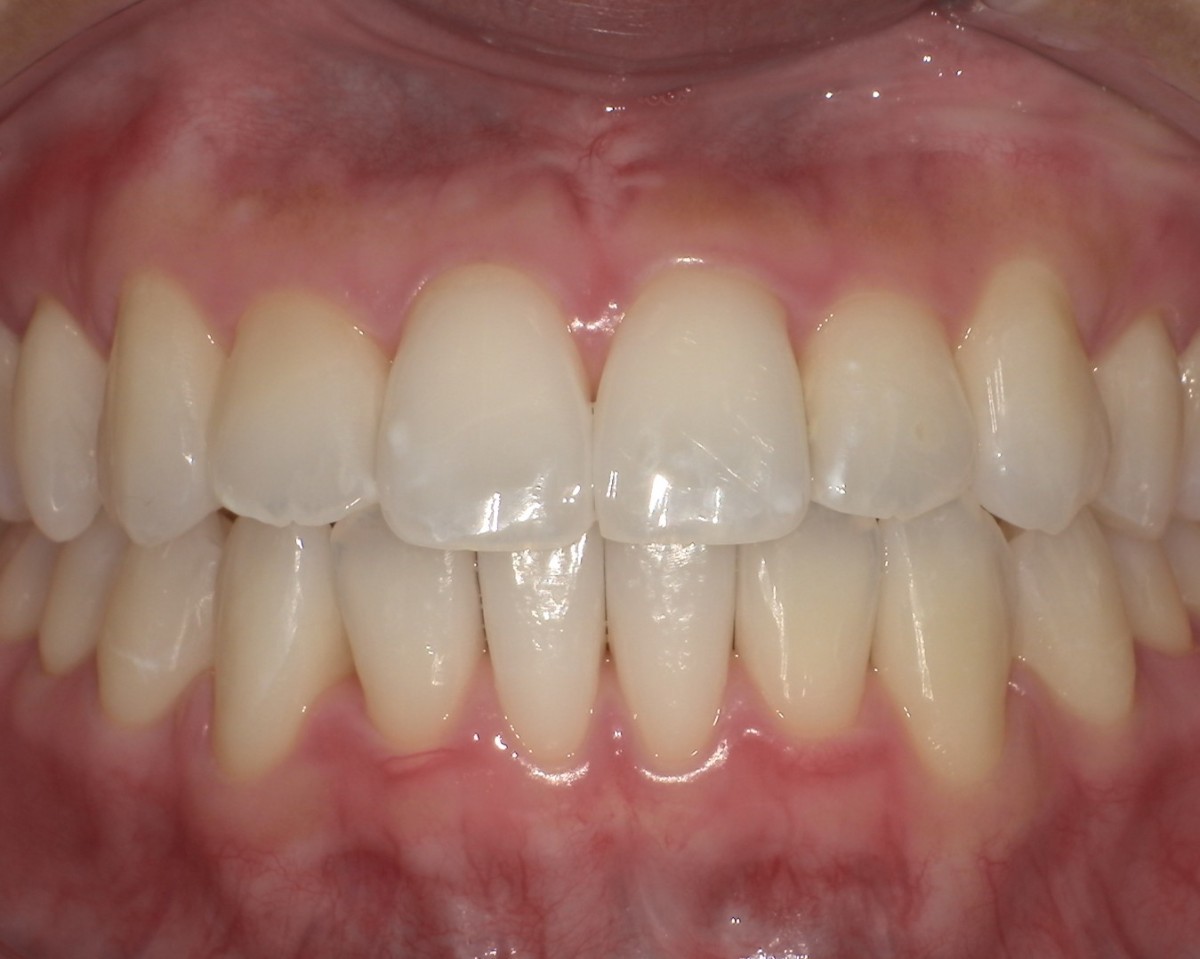 症例2:クロスバイト(交差咬合) After