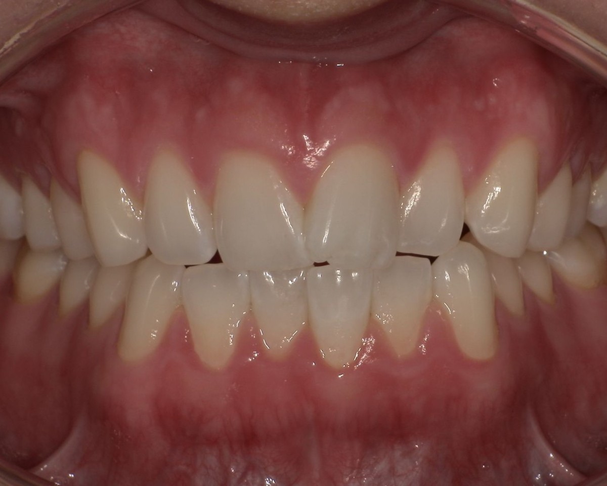 症例1:上下の前歯の叢生(ガタガタ) Before