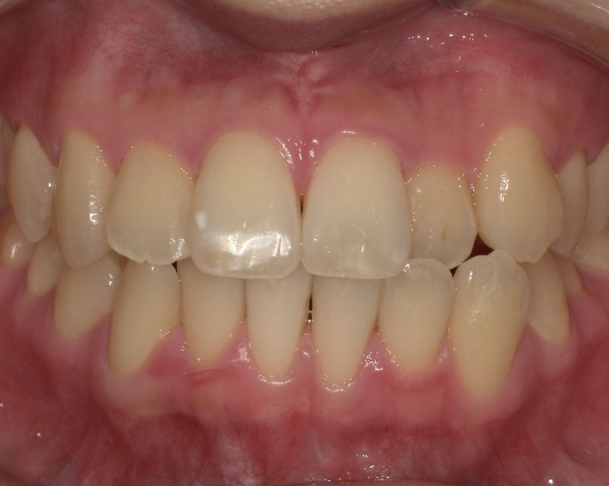 症例2:クロスバイト(交差咬合) Before