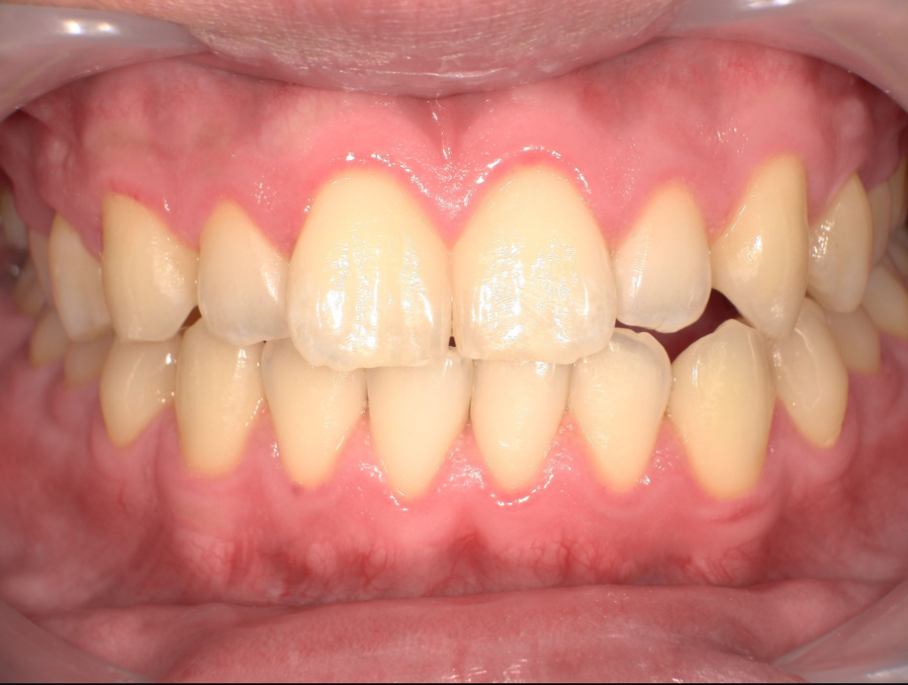 症例2 ビフォー