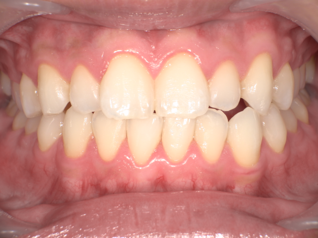 症例2 アフター