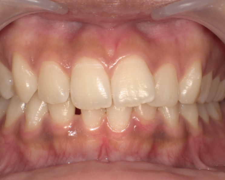 症例1 ビフォー