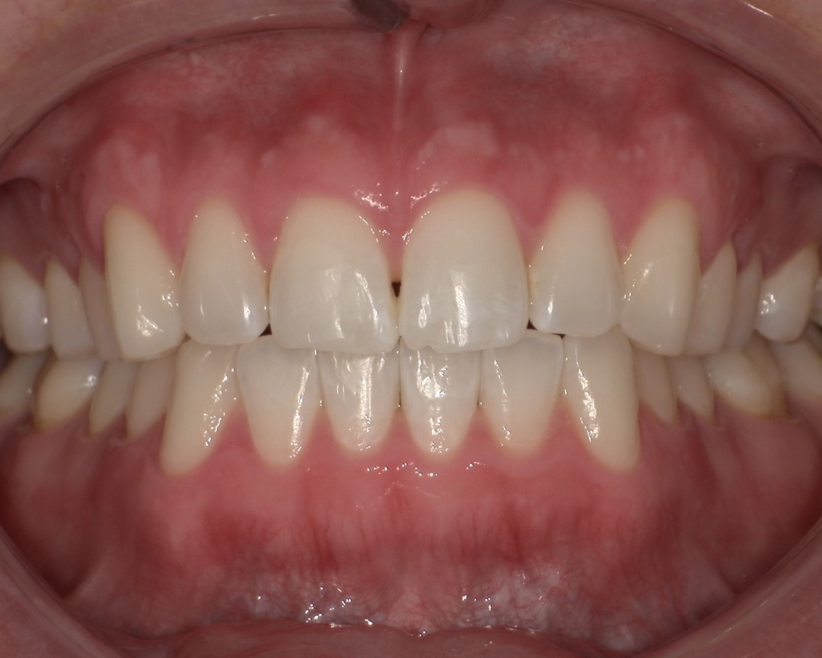 症例1:上下の前歯の叢生(ガタガタ) After