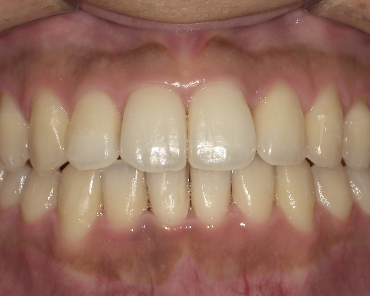 症例3:重度の捻転・叢生(ねじれ・ガタガタ) After