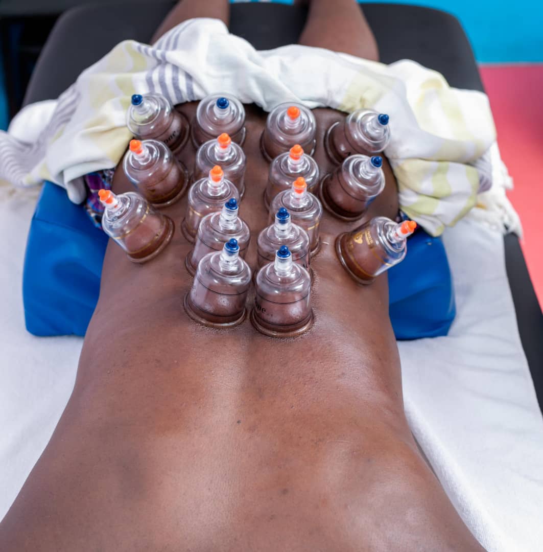 Cupping Therapy Treatment
