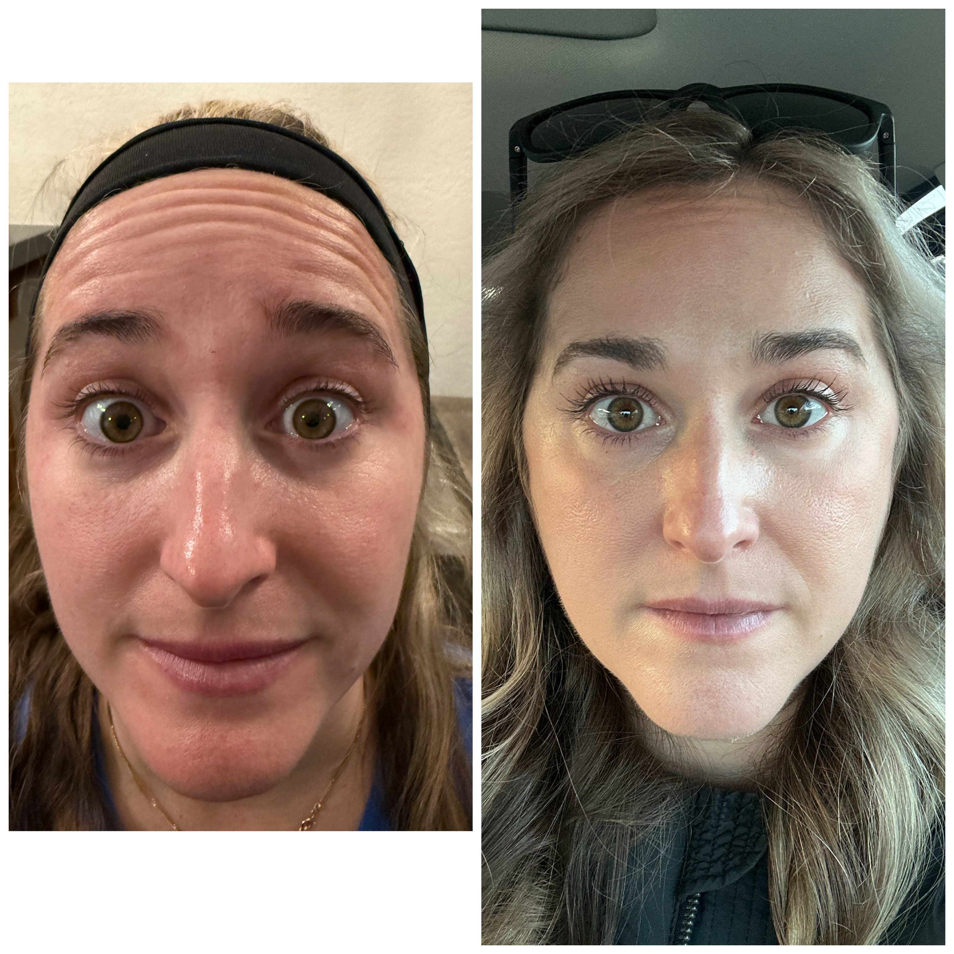 Forehead treatment area