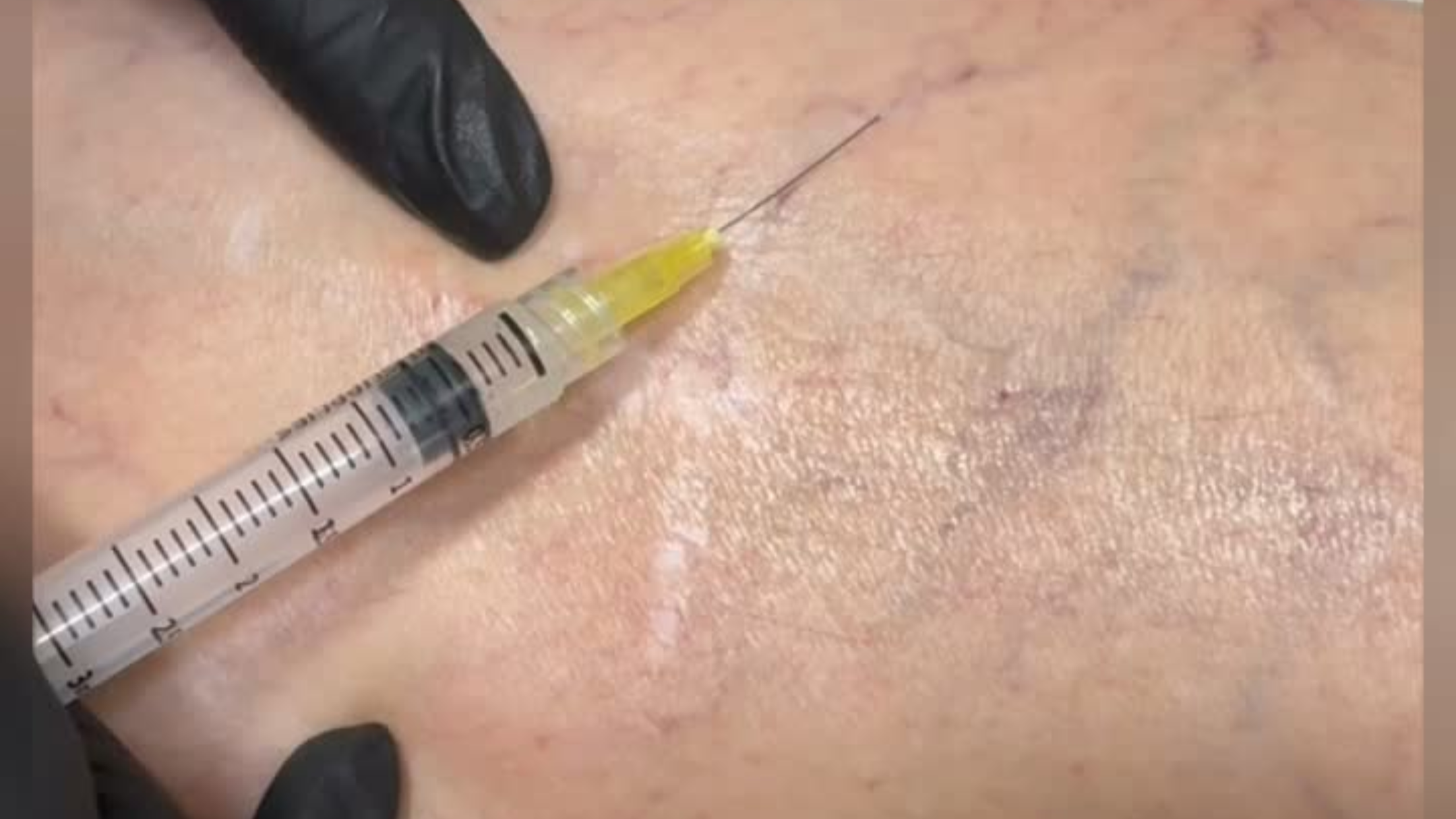 Sclerotherapy treatment