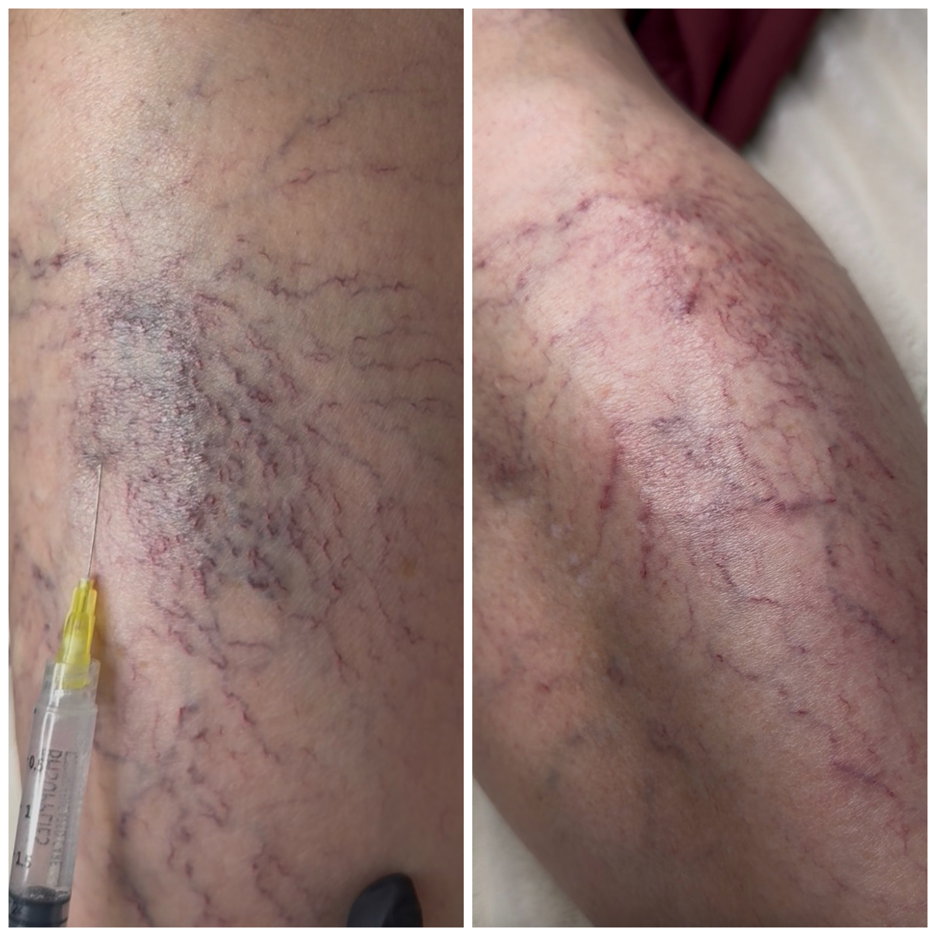 Small Varicose Veins