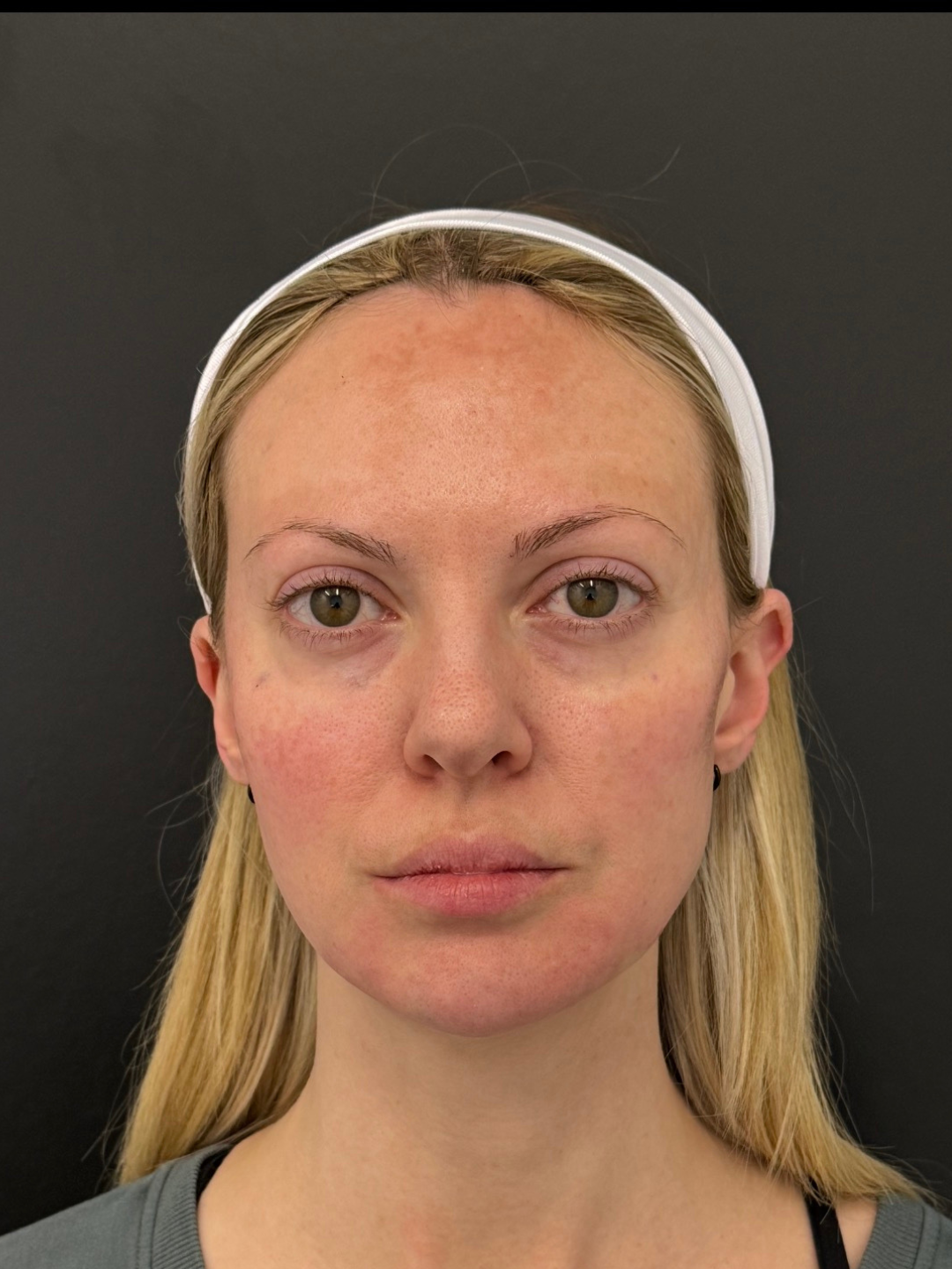 Jaw tension treatment area