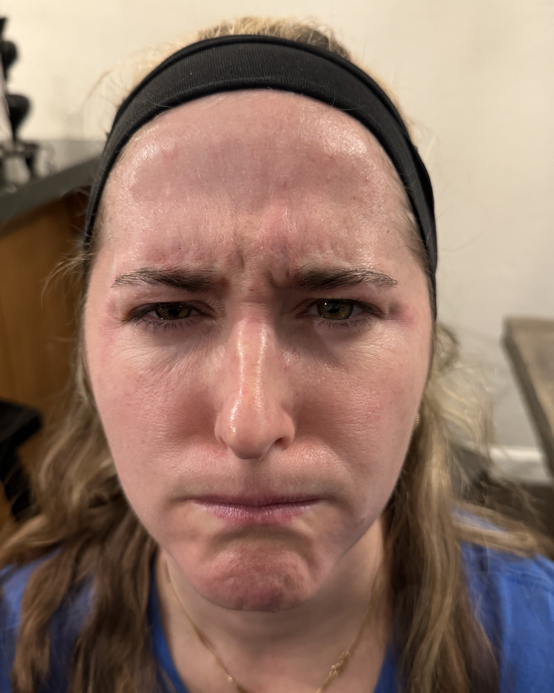 Frown lines treatment area