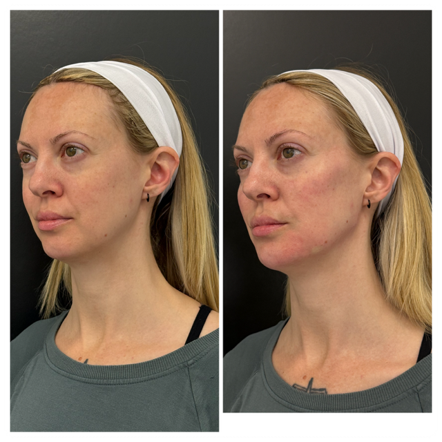 Dermal filler before and after treatment
