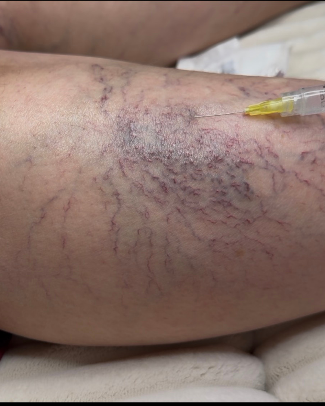 Sclerotherapy treatments