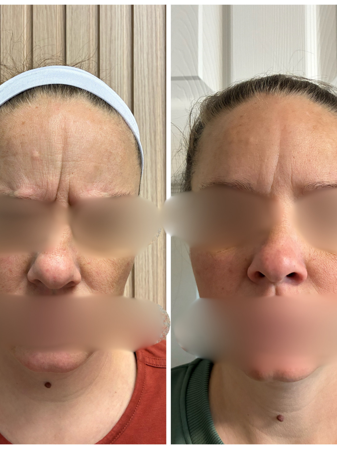 Facial asymmetry treatment