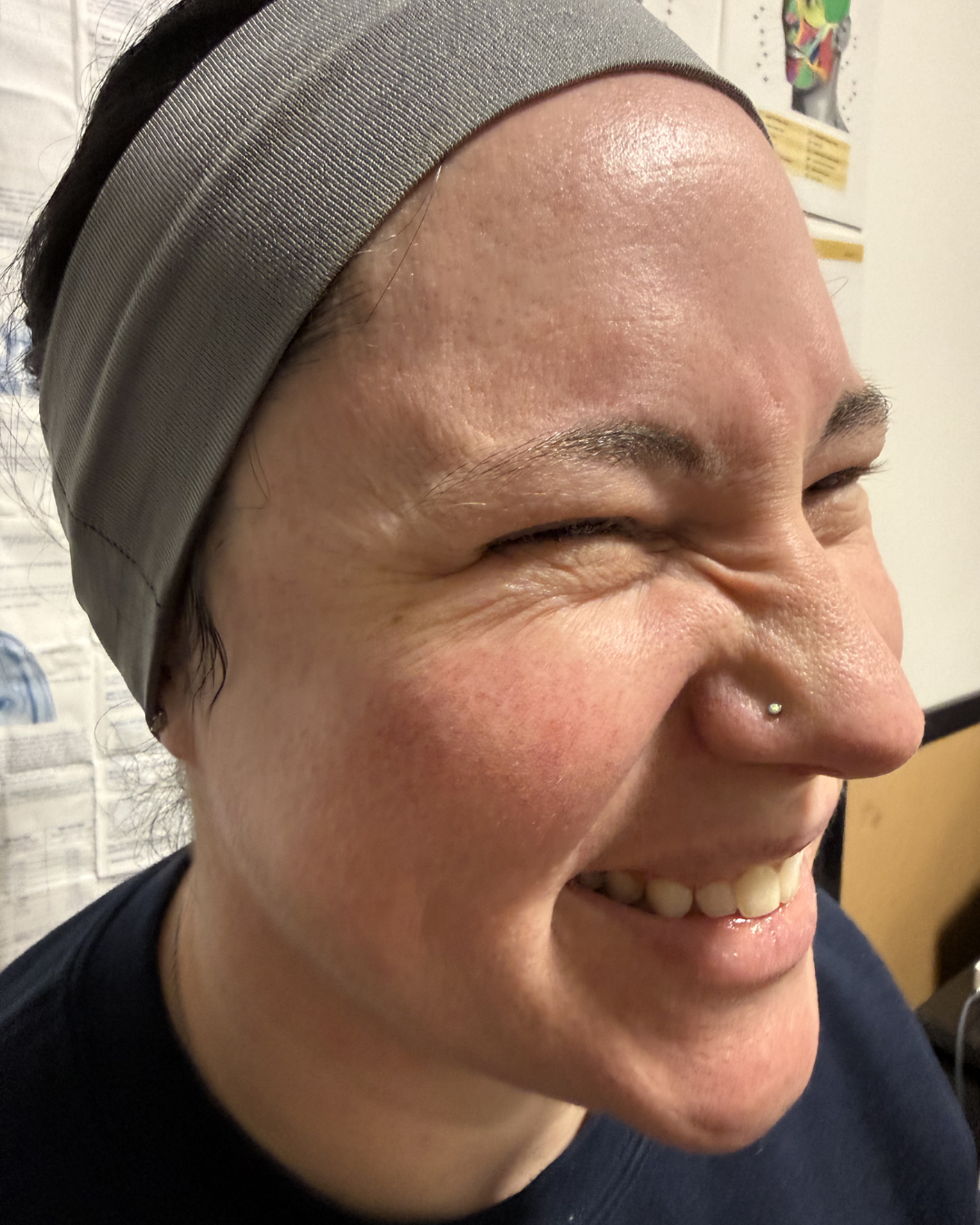 Crow's feet treatment area