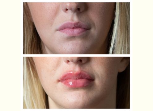 Dermal Fillers