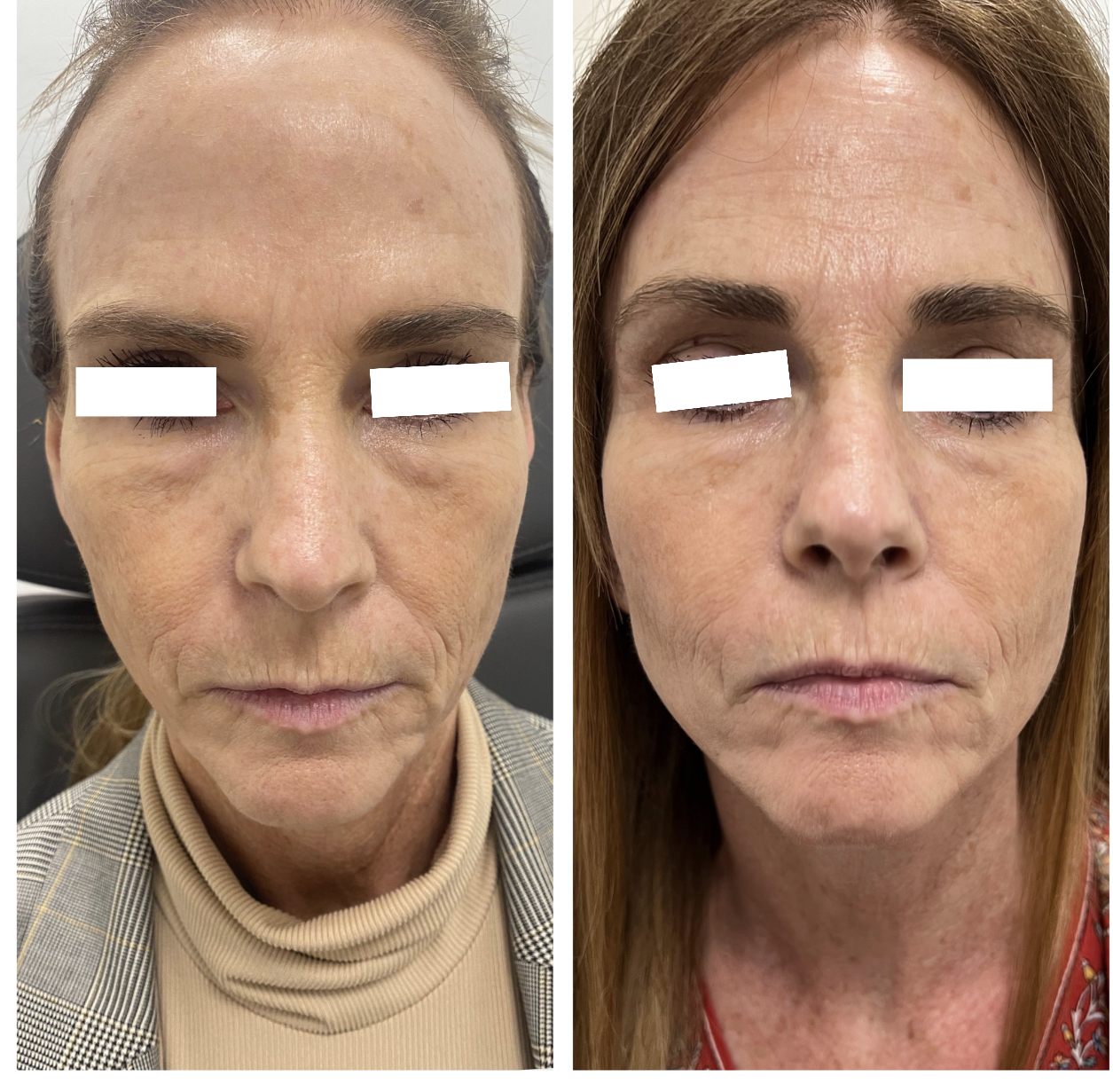 After Rosacea Treatment