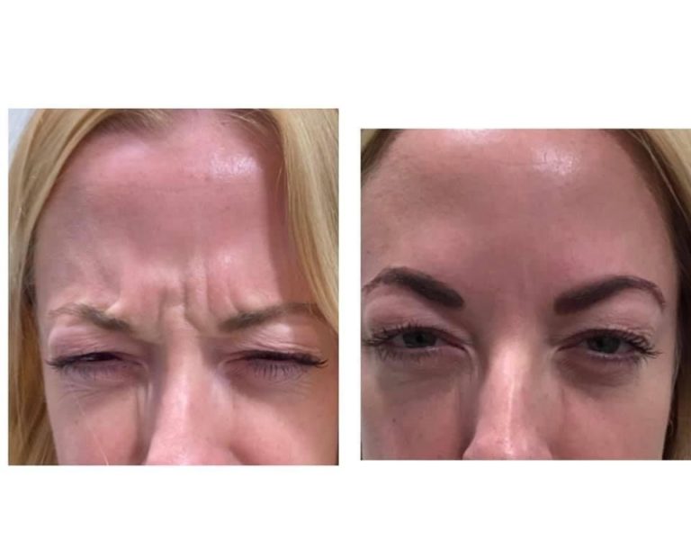 After Forehead Lines & Crow's Feet