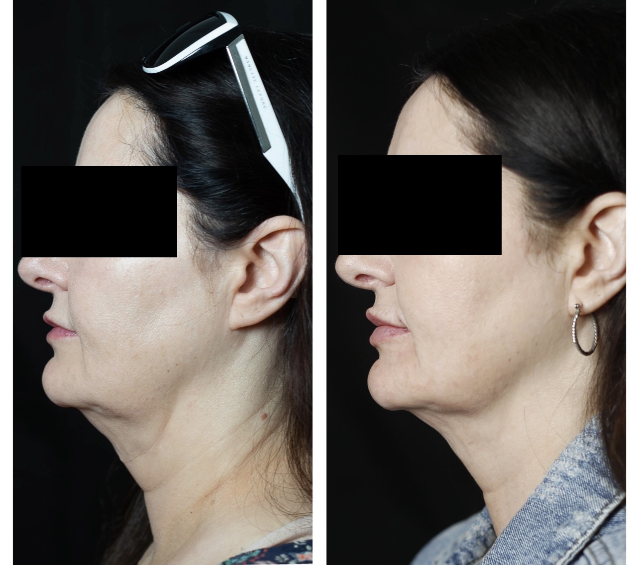 After RF Microneedling Results