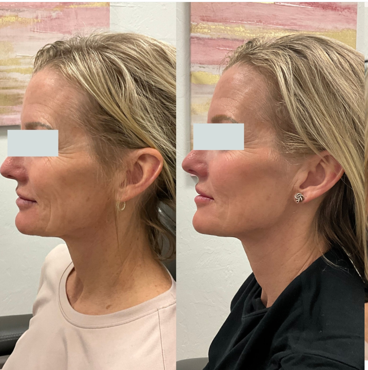 After Melasma Treatment