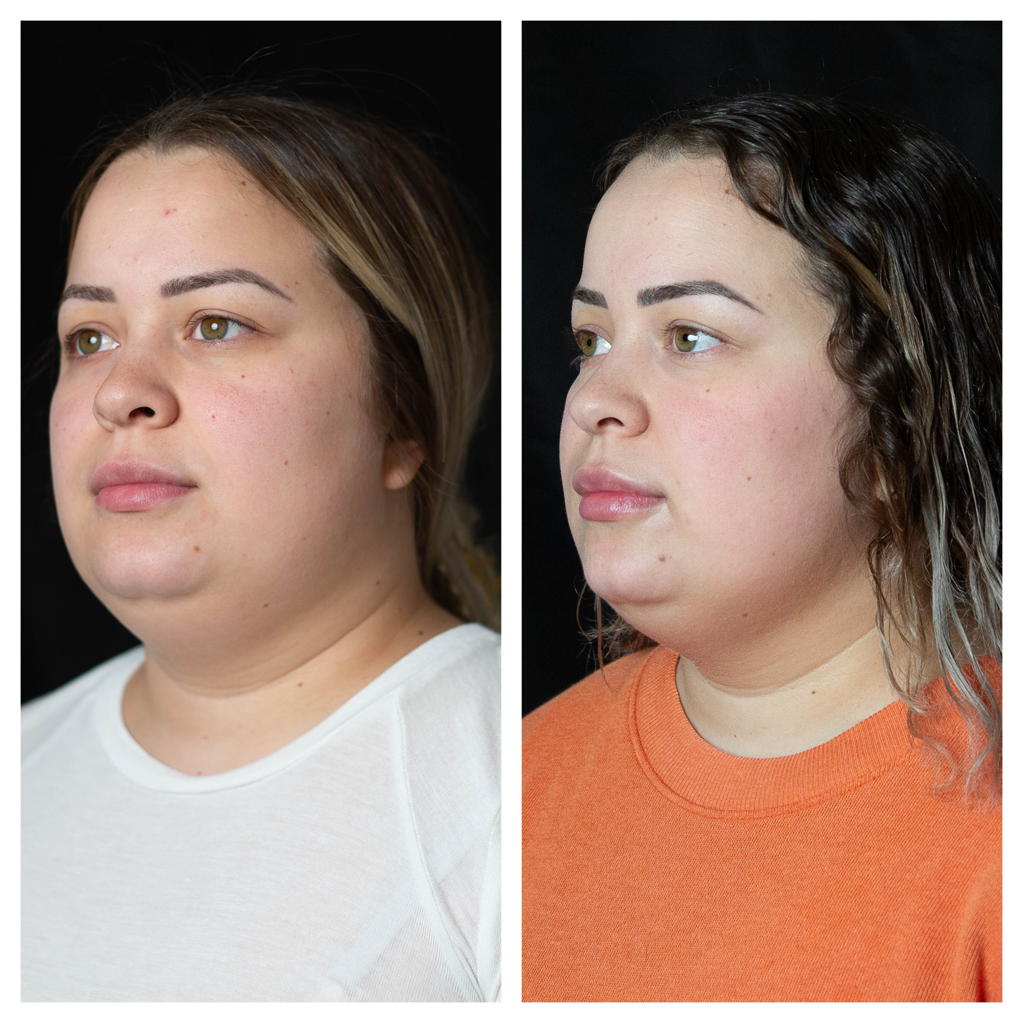 After Under Eye Rejuvenation