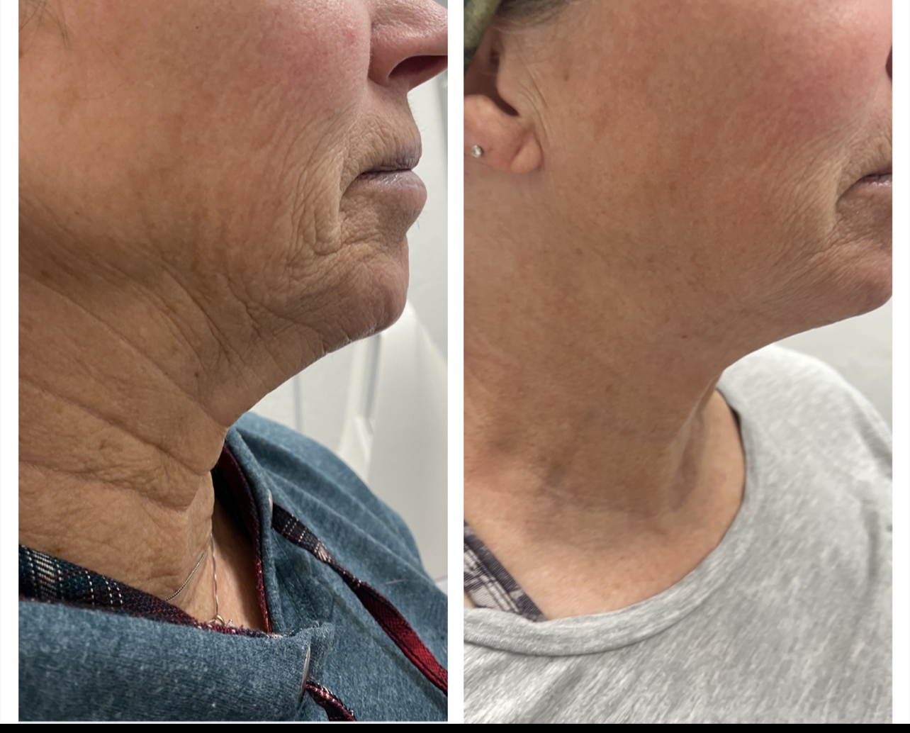 After Acne Scar Treatment