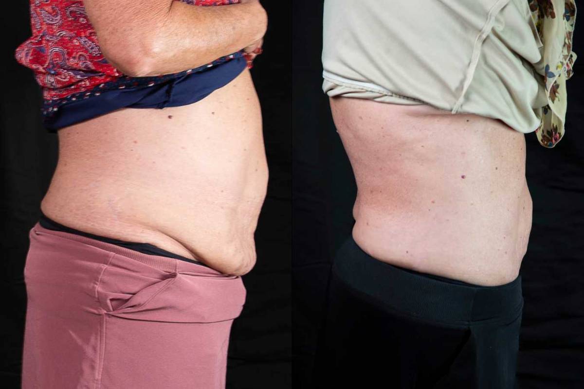 Emsculpt Neo Body Sculpting Results