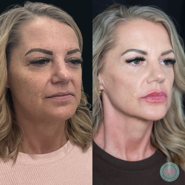 After Natural Lip Enhancement