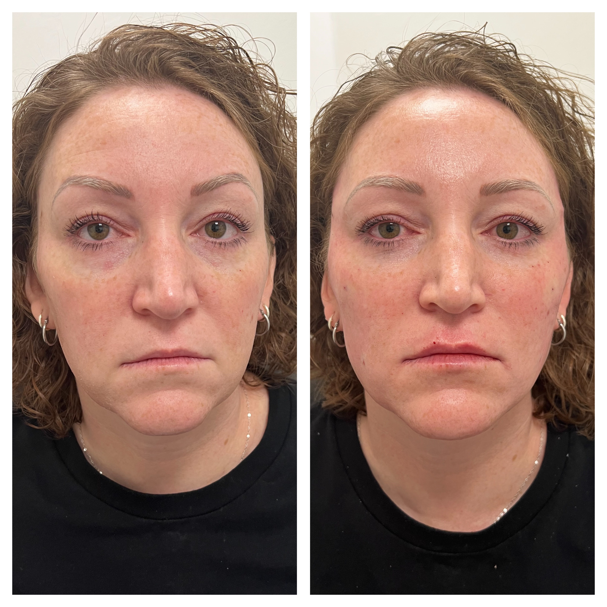 After Nasolabial Fold Reduction