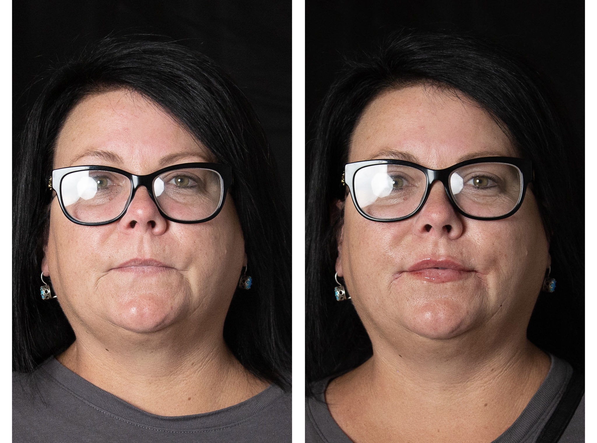 After Cheek Volume Restoration