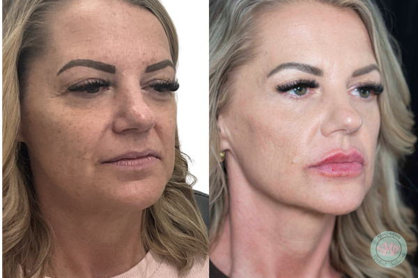 Injectable Treatment Results