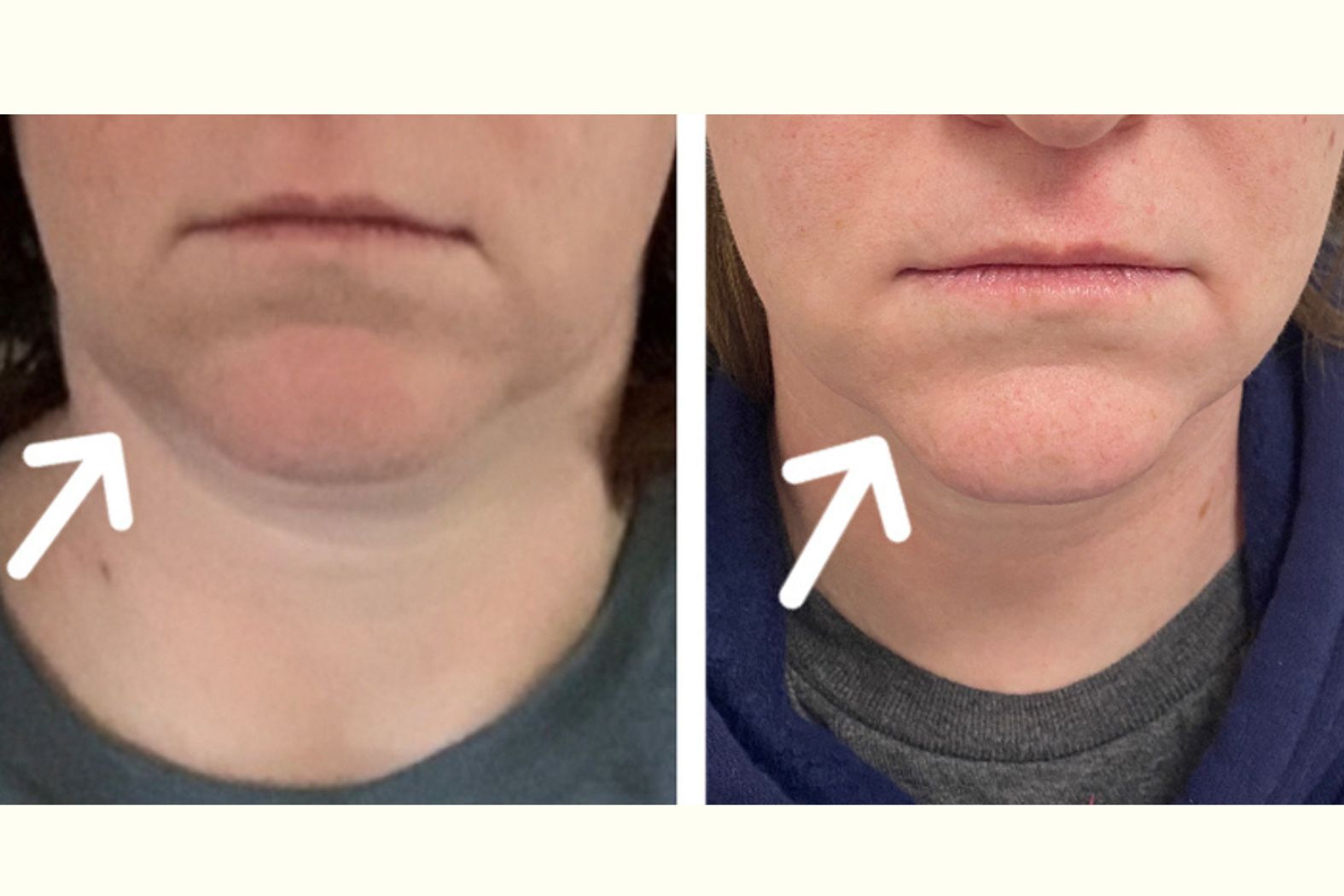 Lipodissolve Treatment