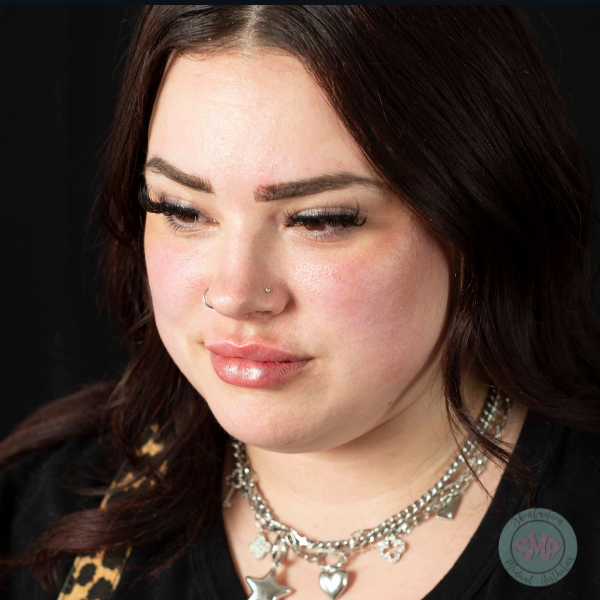 After Lip Asymmetry Correction