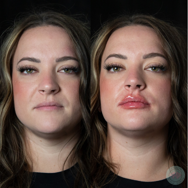After Lip Volume Enhancement