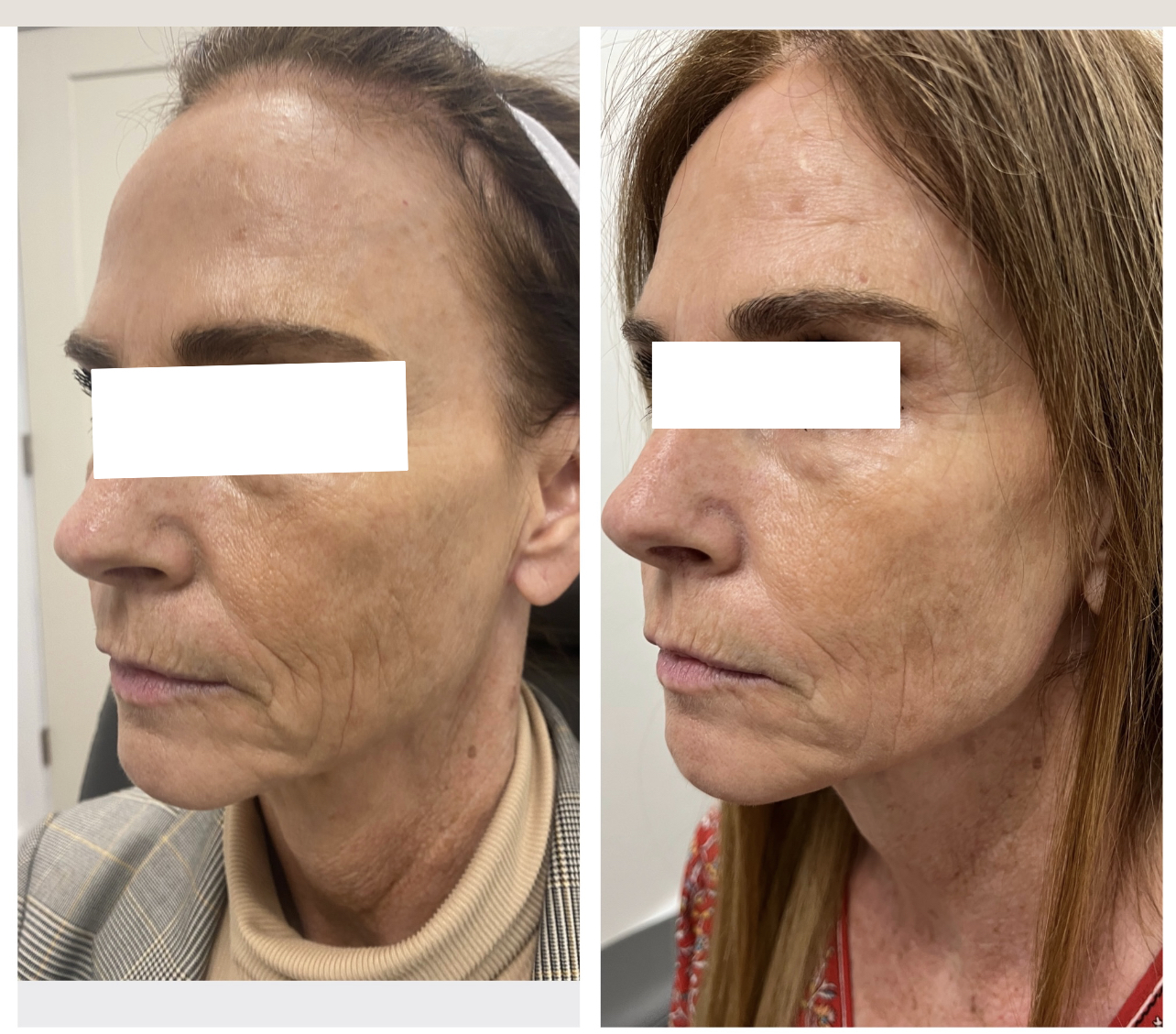 After Skin Tightening Treatment