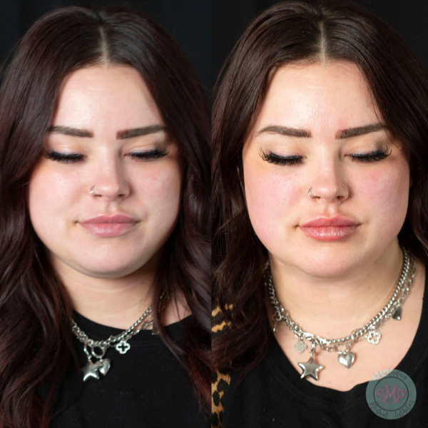After Lip Line Smoothing