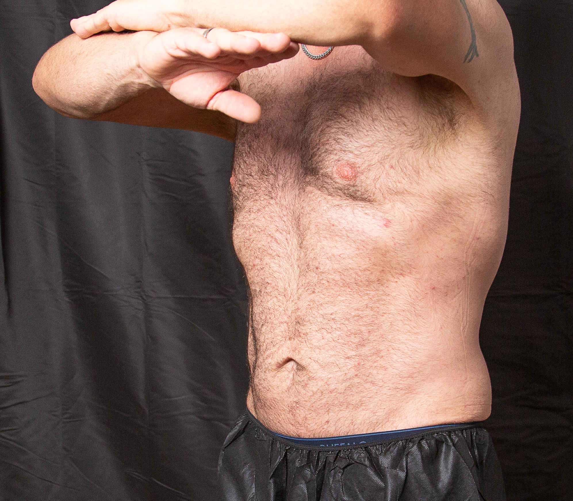 After Arm Contouring