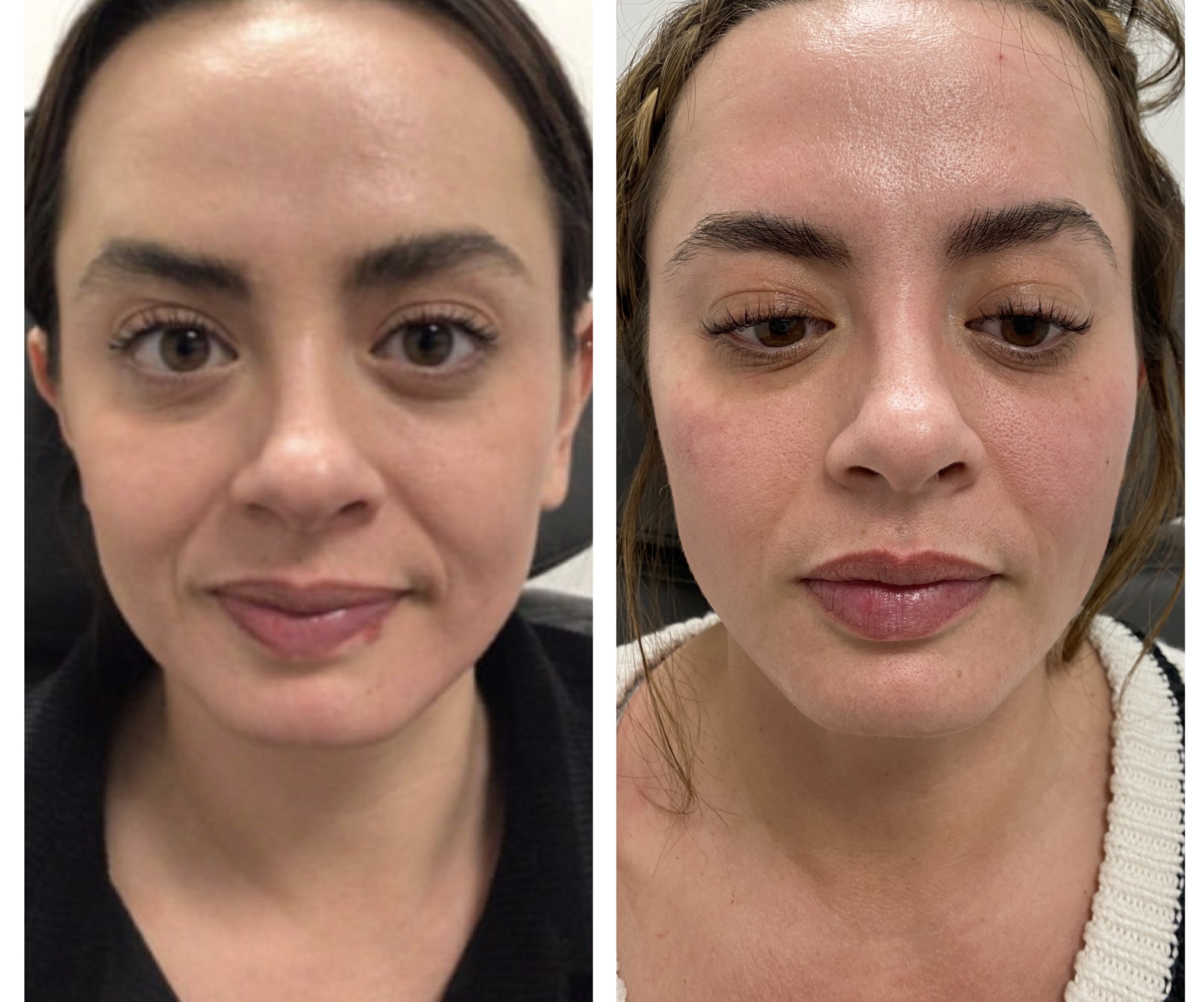 After Jawline Definition