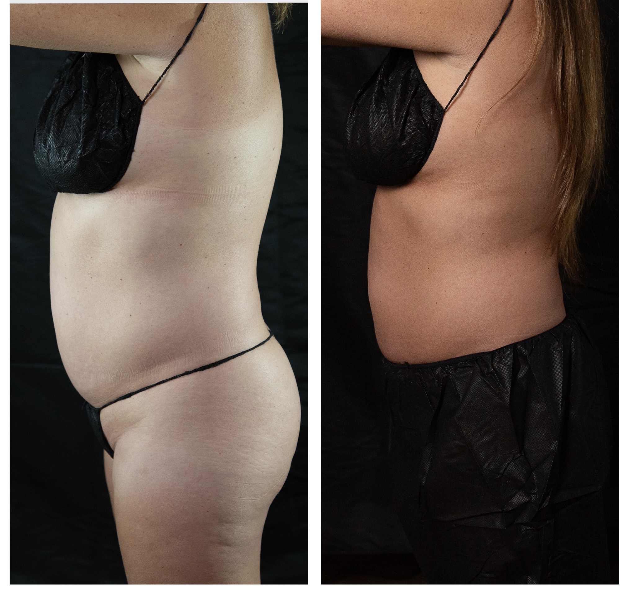 After Body Sculpting Results