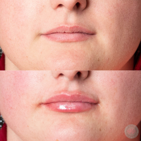 After Lip Border Definition