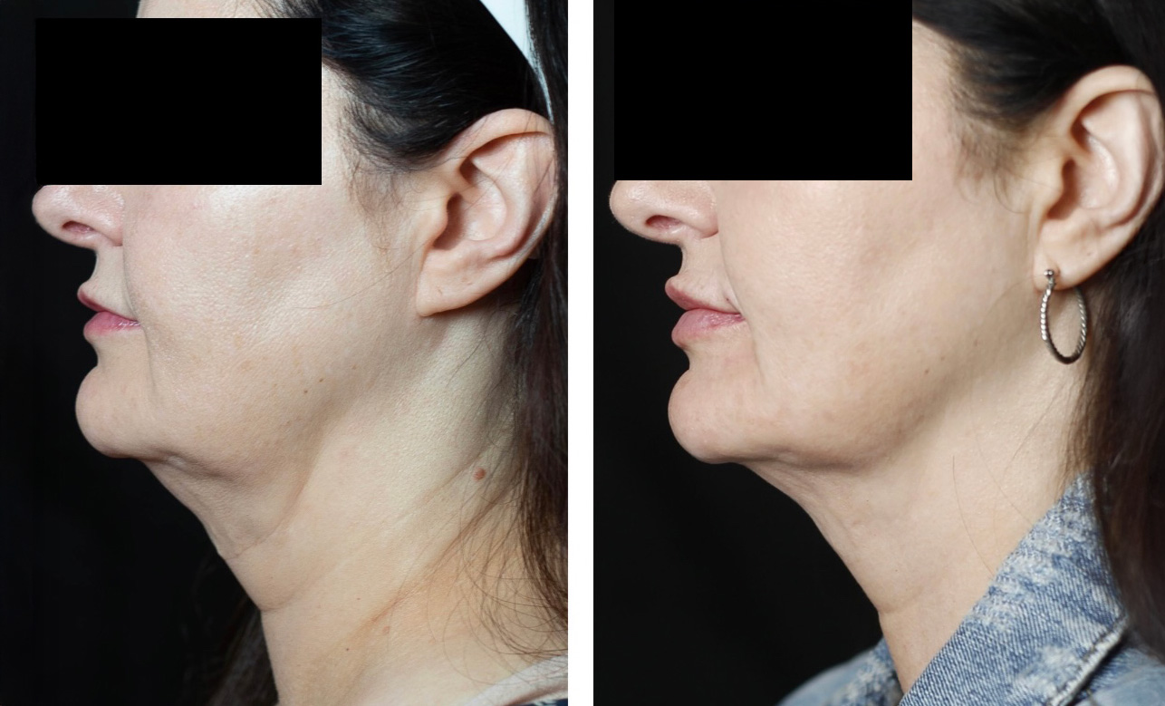 Lip Enhancement Before