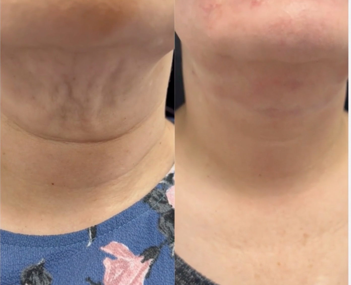 After Sun Damage Reversal