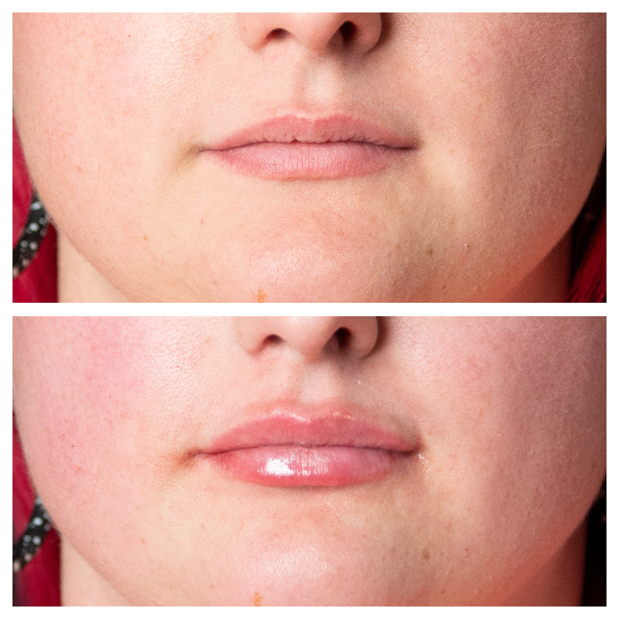 After Brow Lift & Eye Rejuvenation