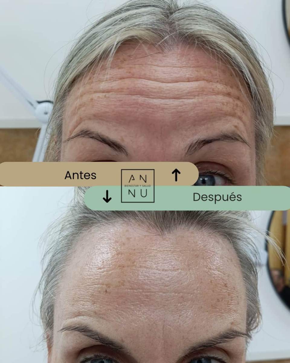 Resultado tratamiento neuromoduladores 2