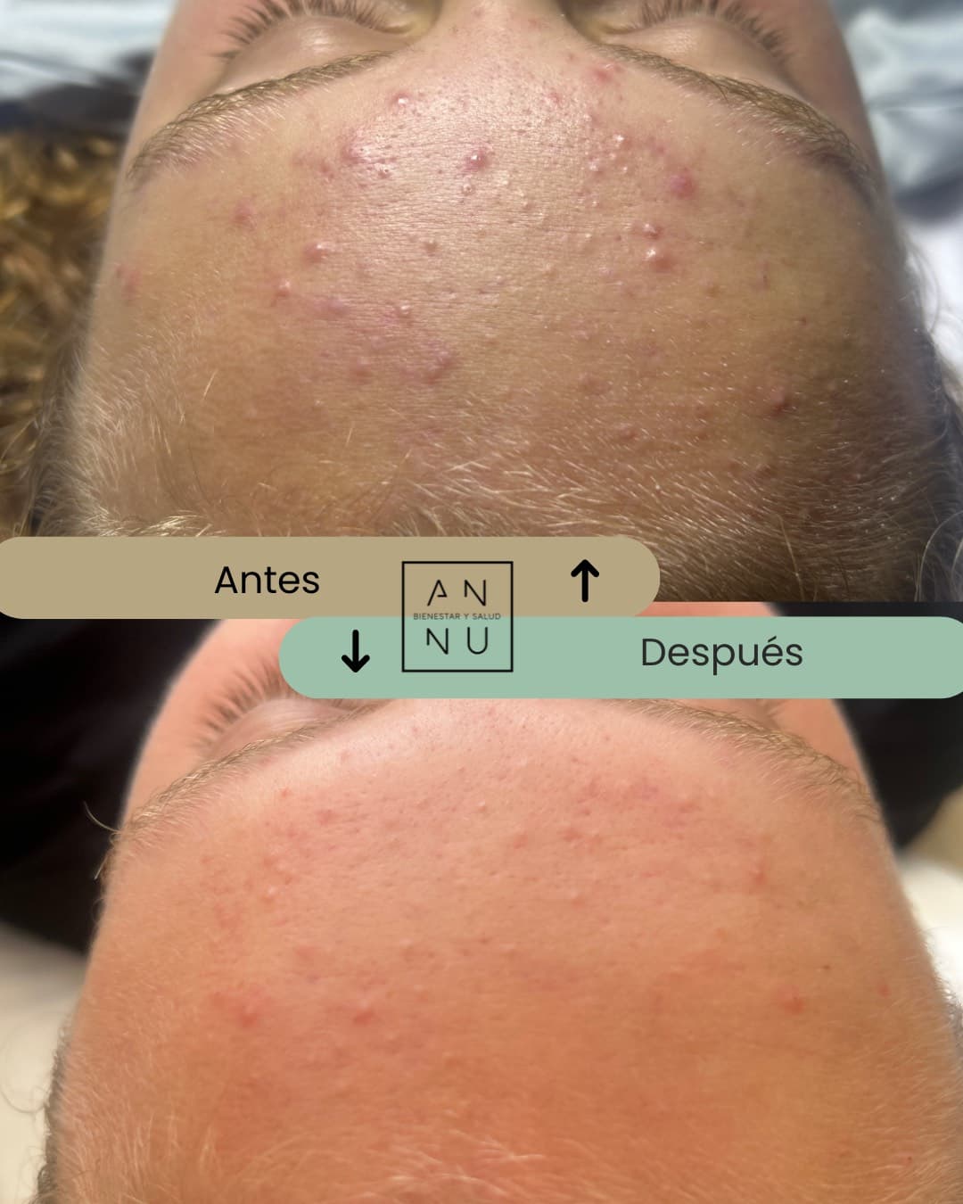 Resultados Tratamiento Acné