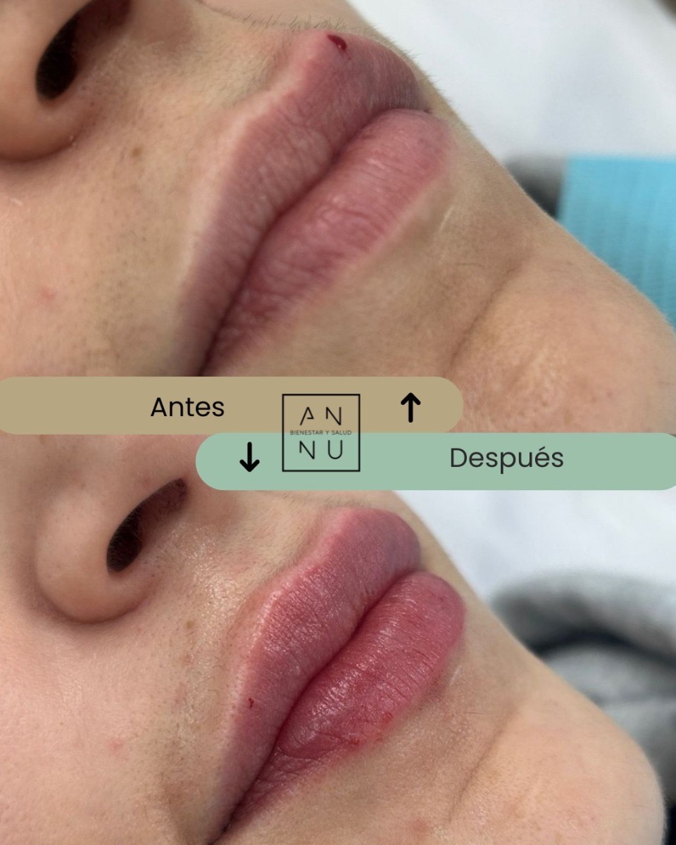 Resultados Ácido Hialurónico - Antes y Después