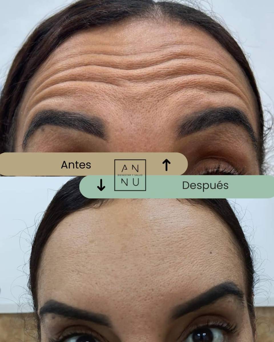 Resultado tratamiento neuromoduladores - Antes y Después