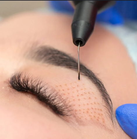 Plasmapen Rejuvenecimiento