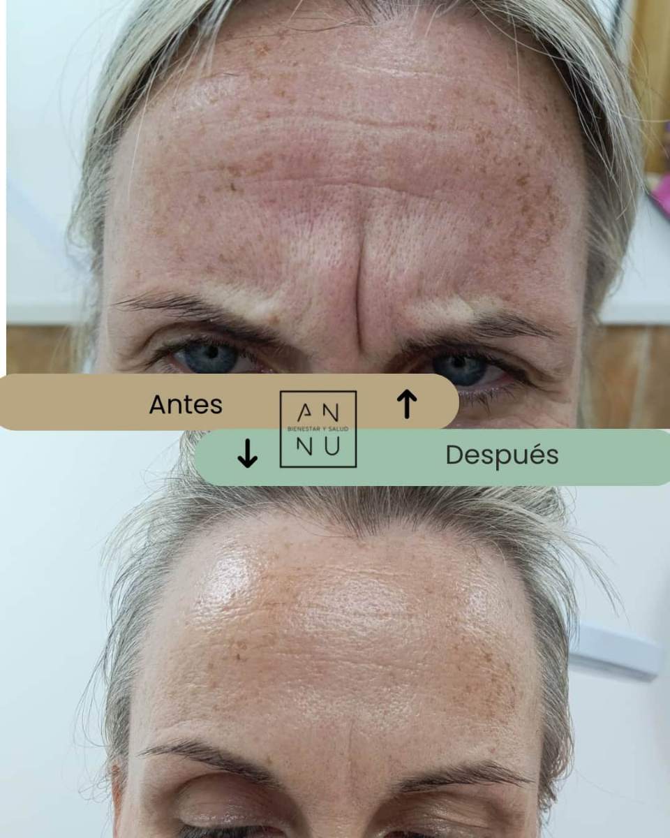 Resultado tratamiento neuromoduladores 4