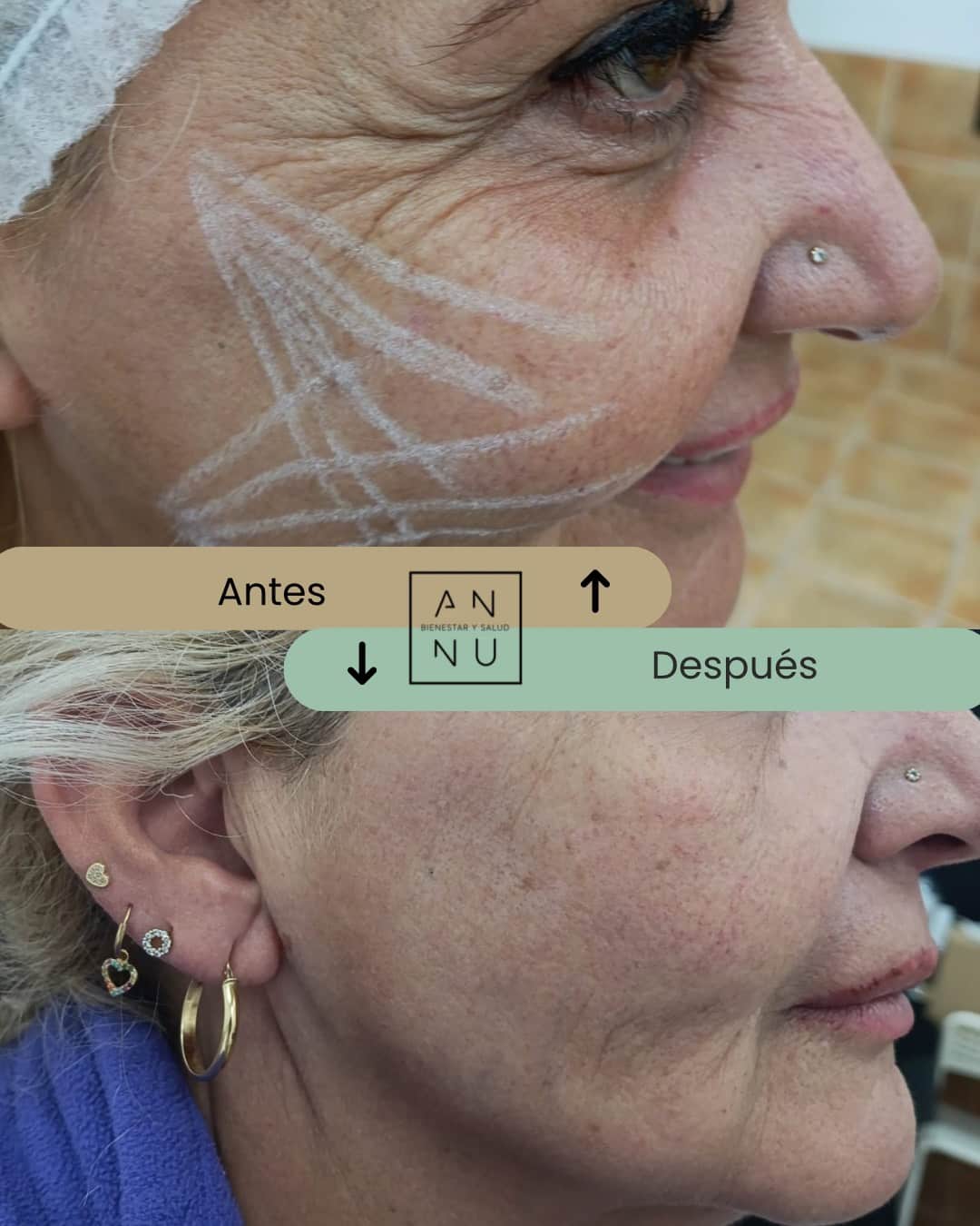 Resultados Estimuladores de Colágeno