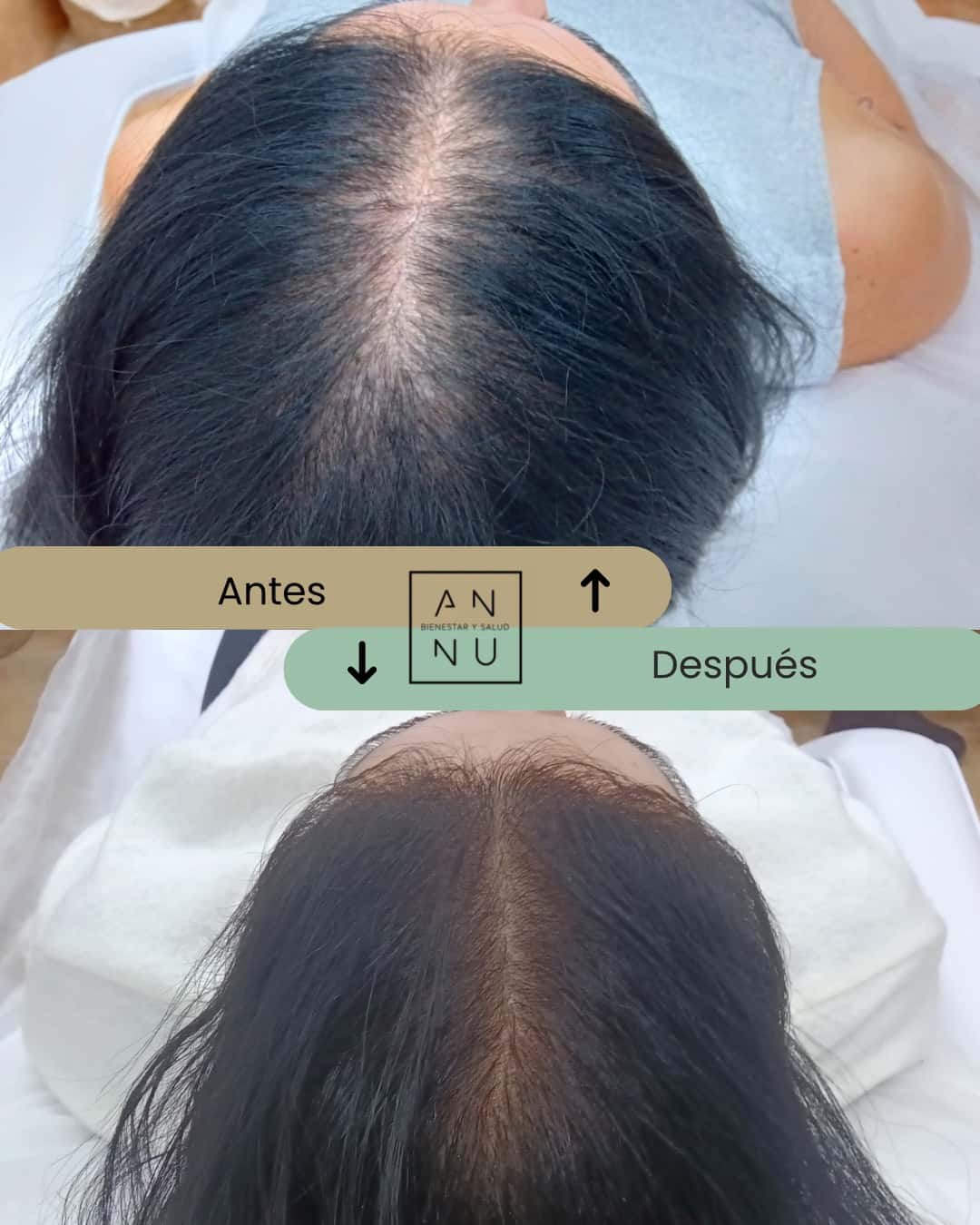 Resultados Tratamientos Capilares